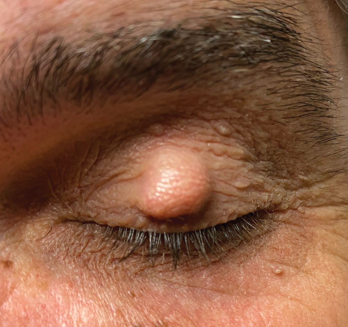 Fig. 3a. Pre-op appearance of a patient prior to a chalazion incision and currettage.