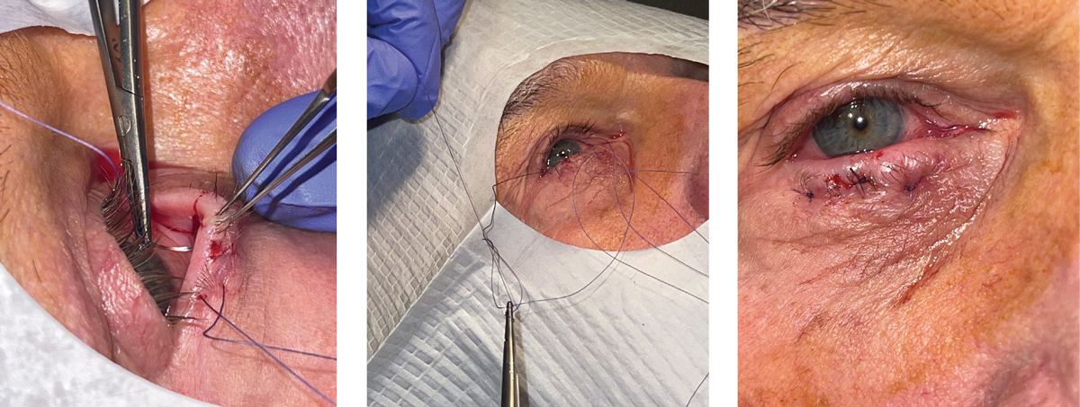 Figs. 3-5. The first arm of the second suture being thrown in the central third of the eyelid (left). Tying of the knots (middle). Immediate post-op appearance (right). Notice the slight ectropion immediately following the procedure, which is the clinical endpoint to shoot for.