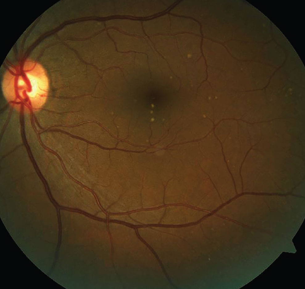 Patient with dry age-related macular degeneration, one of the conditions lutein supplementation can benefit.