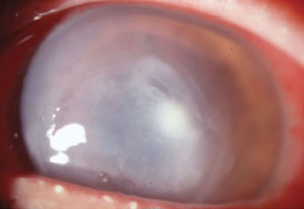Fig. 1. Pseudomonal ulcer in another patient. Untreated infection causes a gray necrosis that can destroy a cornea in 24 hours.