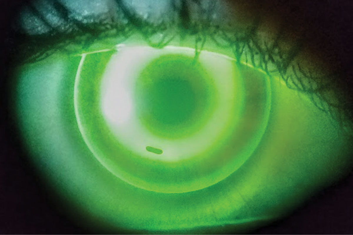 In this well-centered ortho-K lens at initial visit, note the small bubble under the return zone inferiorly. These can be ignored and will generally dissipate as the reshaping occurs in the first 24-hour period. You could also instruct the patient to overfill the lens with a viscous artificial tear prior to insertion.