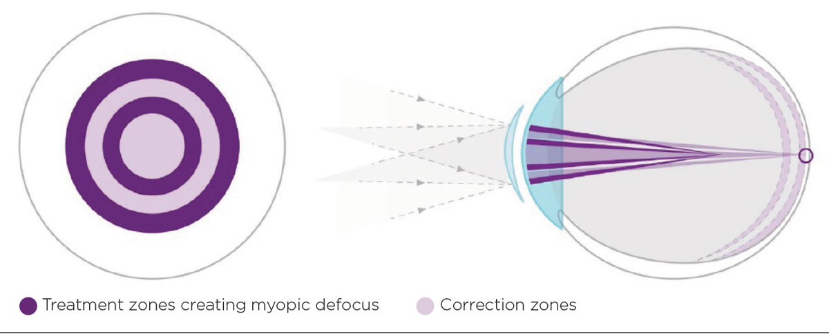 The MiSight 1 Day lens uses what the manufacturer calls “ActivControl technology,” consisting of two discrete rings with a +2.00D add (dark purple) to create myopic defocus on the retina.