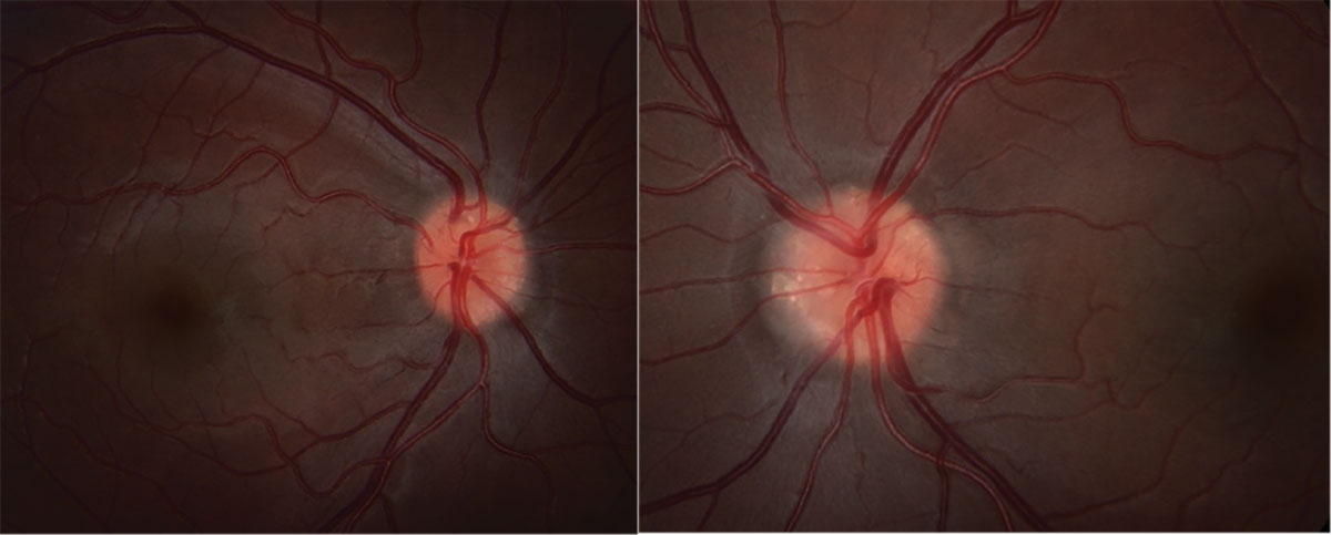 Fig. 1. Fundus photos of OD (left) and OS (right).