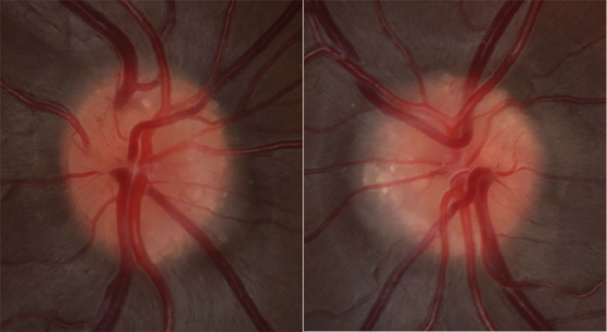 Fig. 2. High magnification optic nerve photos of OD (left) and OS (right).