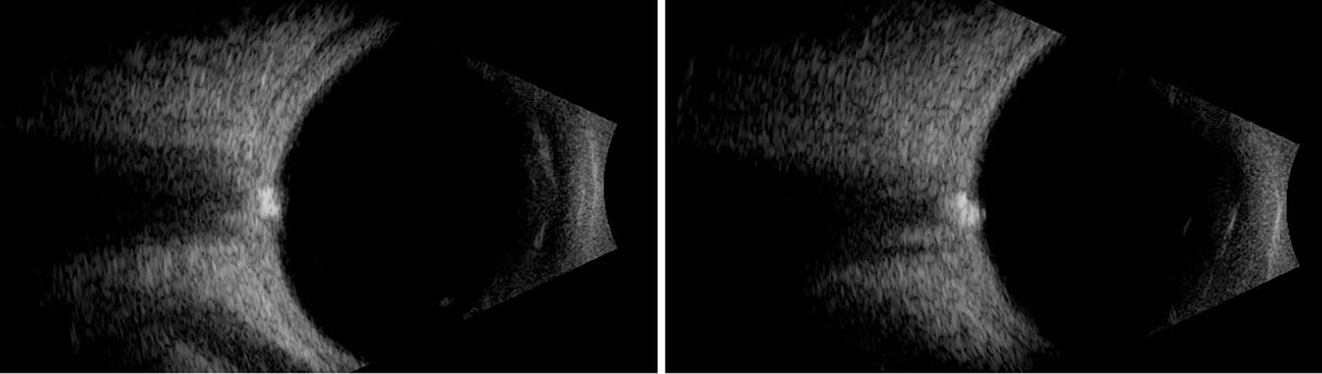 Fig. 4. B-scan ultrasound horizontal axial scans over the nerve OD (left) and OS (right).