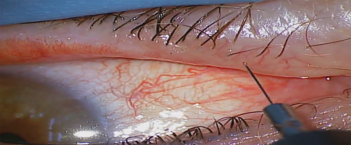 Micro-insulated electrode shown in this photo. The electrode should be inserted adjacent to the eyelash to the base of the follicle.