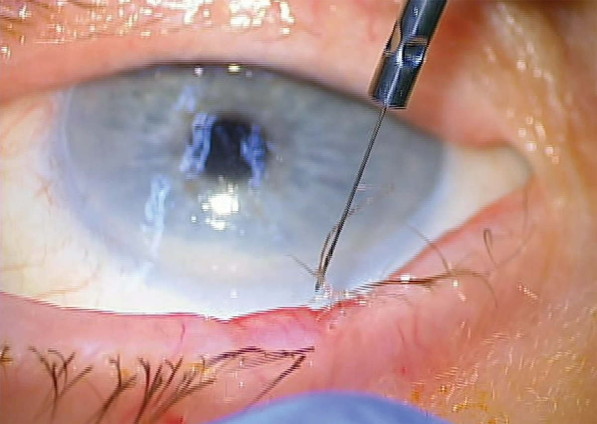 The ideal endpoint of radiofrequency ablation of lashes is the lash being coagulated and sticking to the electrode.