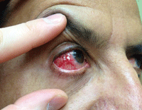 Steroid eye drops lotemax
