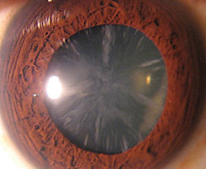 Steroid induced cataracts
