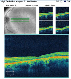SD-OCT images show the patient’s retinal state in both the right and left eye.