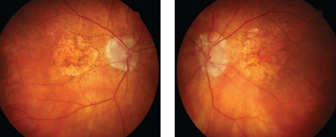 Fig. 2. Advanced atrophic AMD may masquerade as angioid streaks.