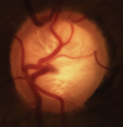 Glaucomatous cupping with characteristic loss of neuroretinal rim, lamina and alteration of the vasculature. 