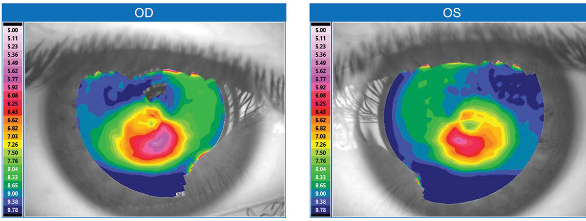 Fig. 1. This topographical map is typical for a keratoconus patient.