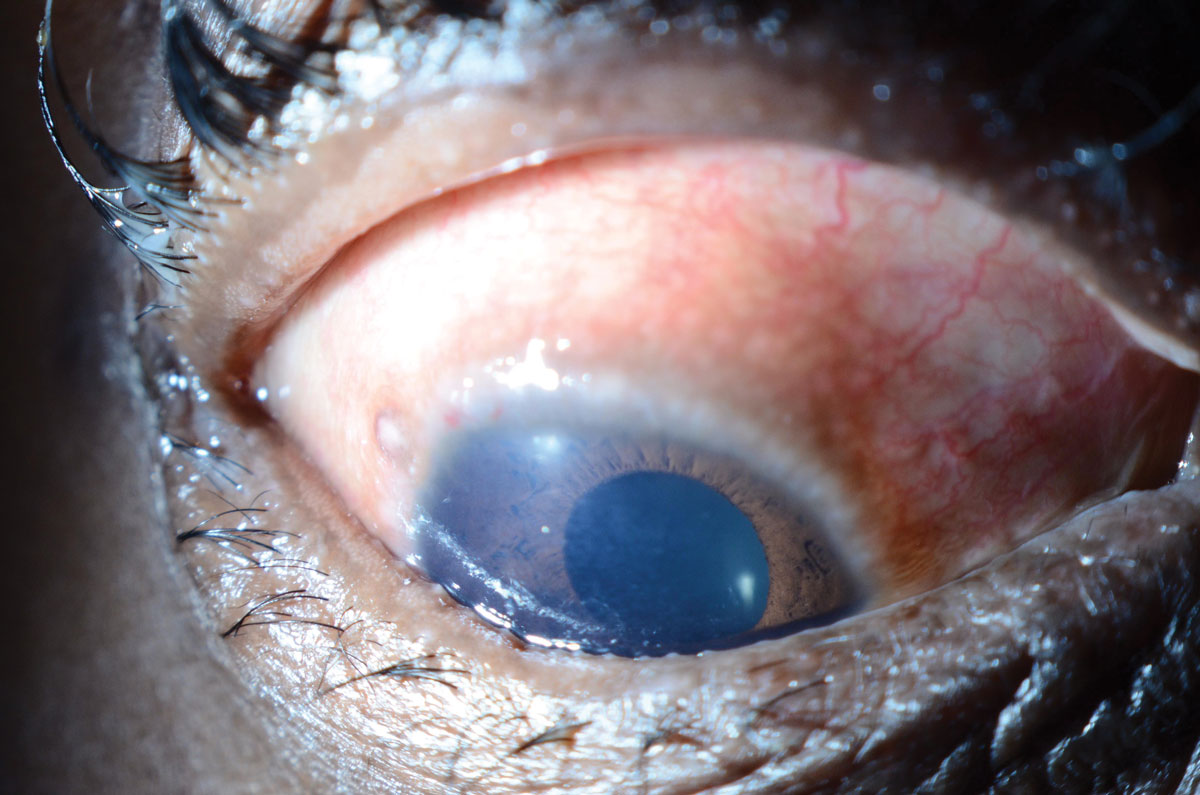 Fig. 3. This patient with vernal keratoconjunctivitis presented with limbal Horner-Trantas Dots.