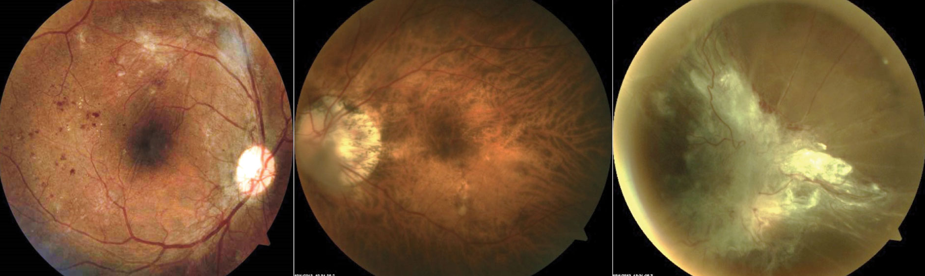 Fig. 3. These fundus images show, from left to right, a patient who has high risk PDR OD: >1/4D-1/3D of NVD inferiorly and NVE superiorly with fibrovascular tissue causing vertical retinal folds through macula; a patient with high myopia (-11.50DS), which can be protective against DR; large posterior vitreous detachment in front of the optic nerve head in the right eye of a patient who failed to seek treatment for PDR.