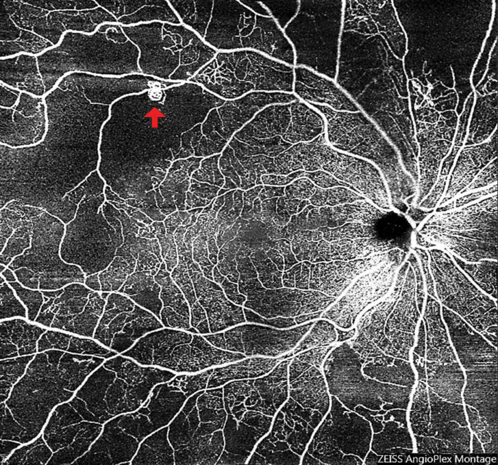 Fig. 9. Widefield OCT-A of an eye with subtle neovascularization (arrow) led to a diagnosis of early proliferative diabetic retinopathy. Also note the significant peripheral retinal nonperfusion. 