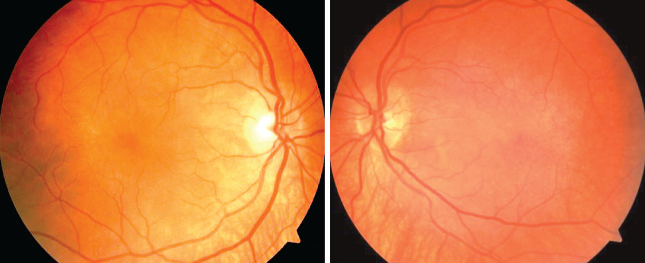 The patient’s dilated fundus exam revealed a post-equatorial hypopigmented choroid as well as choroidal folds in the right and left eyes.