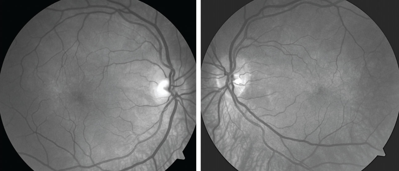 Red-free images show broad areas of choroidal hypopigmentation, most prominent in the area inferior to each optic disc.