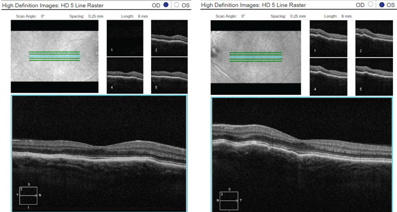 OCT 5-line raster scans of both eyes demonstrated a normal retina, but slight thinning of choroidal tissue and subtle choroidal folds.