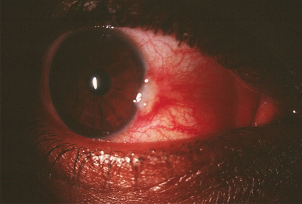 This patient’s red eye has been getting progressively worse. Can anything about this image and the diagnostic data help explain why?