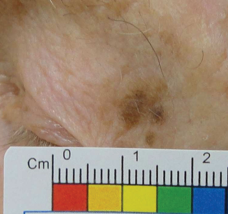 Melanoma in situ of the lateral upper eyelid. Note the lesion’s asymmetry and irregular borders, satellite lesions and variable pigmentation.