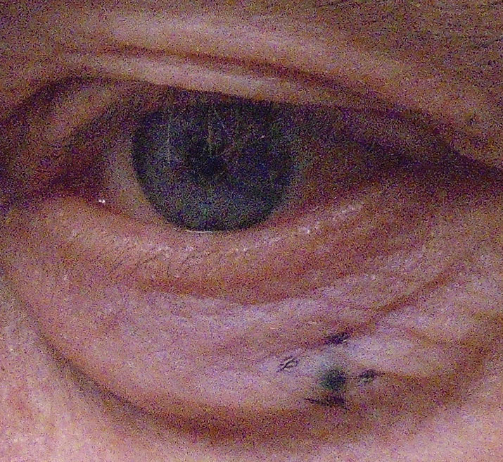 Nodular melanoma of the lower eyelid.