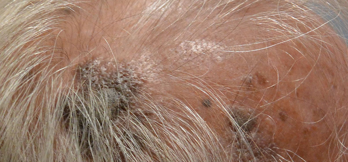 Typical appearance of SK, seen here on the scalp.