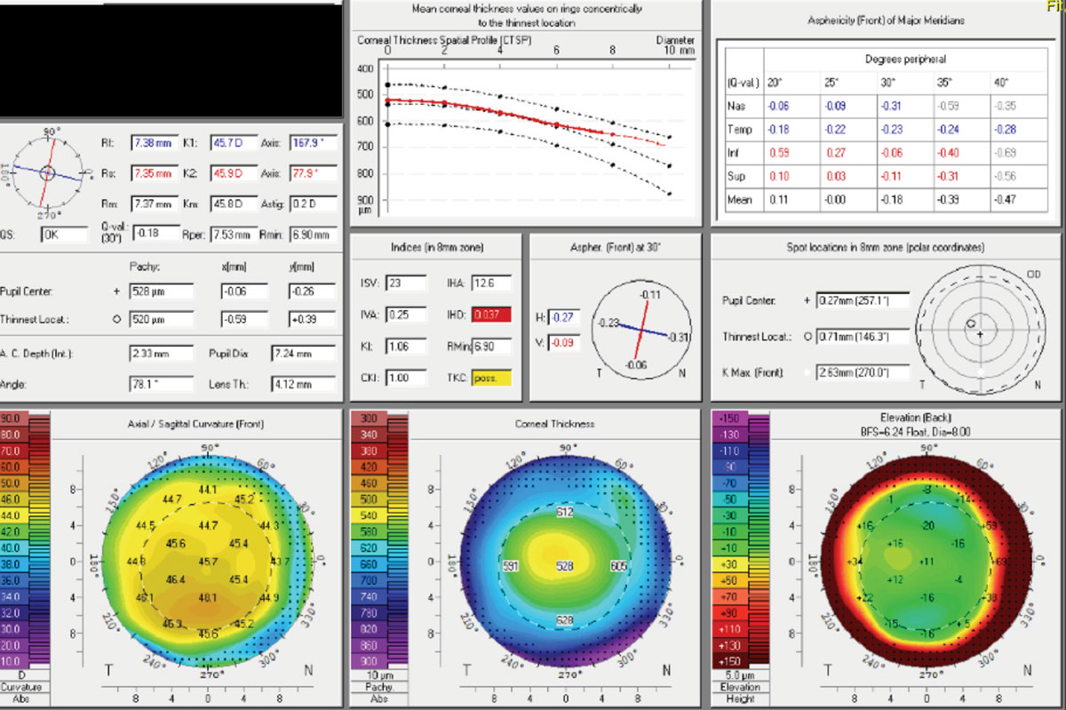 Forme fruste keratoconus can be subtle and is often missed in routine eye exams. Tools such as the Pentacam help identify those with irregular astigmatism as these patients are contraindicated for toric and presbyopia-fixing IOLs.