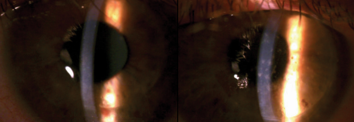 Fig. 1. Upon presentation, scattered SEIs were noted throughout the right corneal graft along with temporal graft edema (left). The left corneal graft was remarkable for scattered SPK; no SEIs or graft edema were noted (right). 