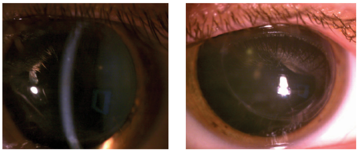 Fig. 2. At left, after aggressive steroid use and several visits with ophthalmology, this right corneal graft was finally clear. Though the left graft did not undergo rejection throughout this case, a photo of the left eye was provided for contrast.