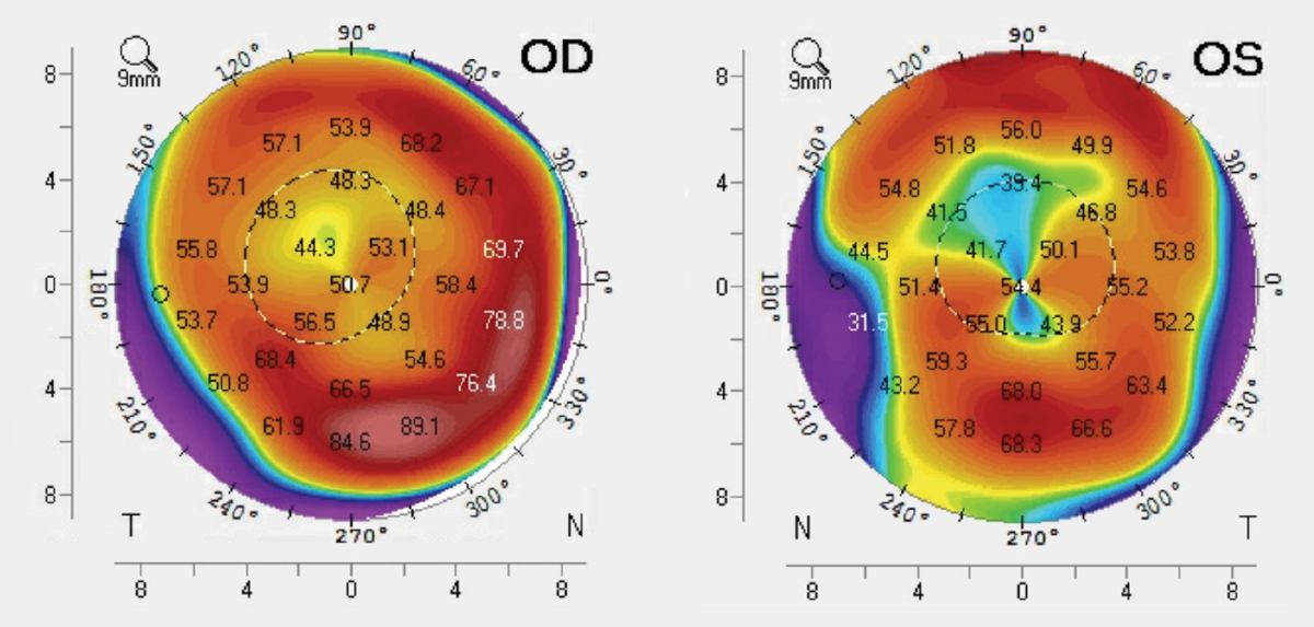 Fig. 3. These tangential curvature maps show our patient’s corneal topography.