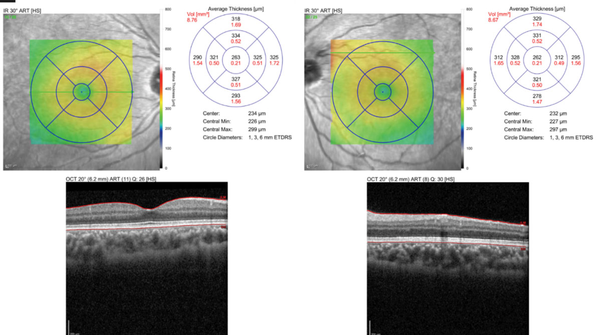 Fig. 5. OCT macular scan shows no structural abnormalities.