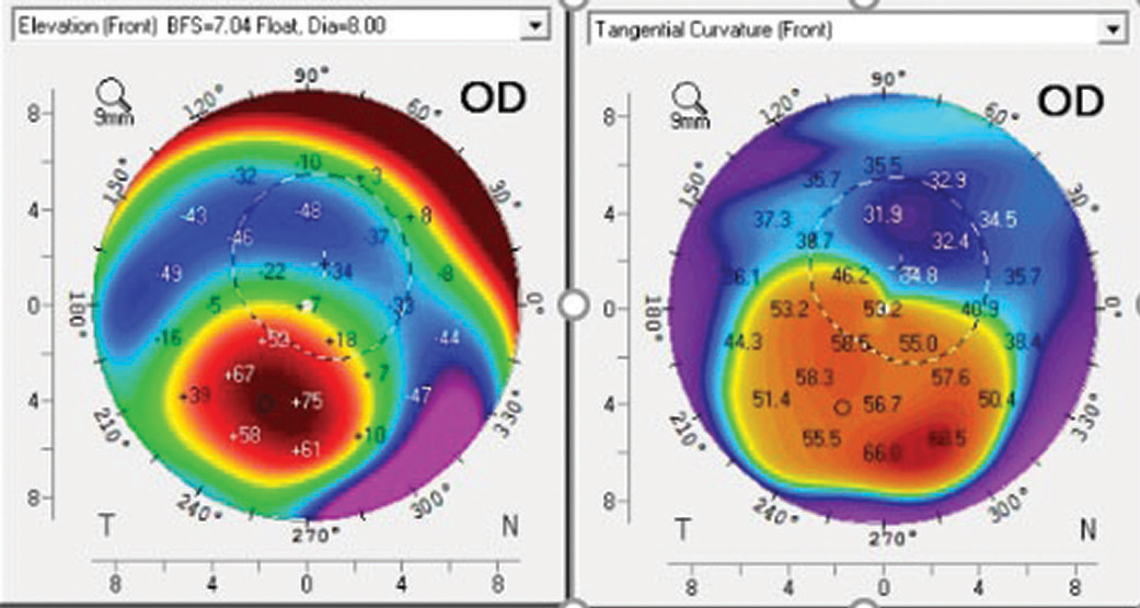 Fig. 5. Corneal topography of a post-PK patient shows the corneal apex is outside the center of the cornea.