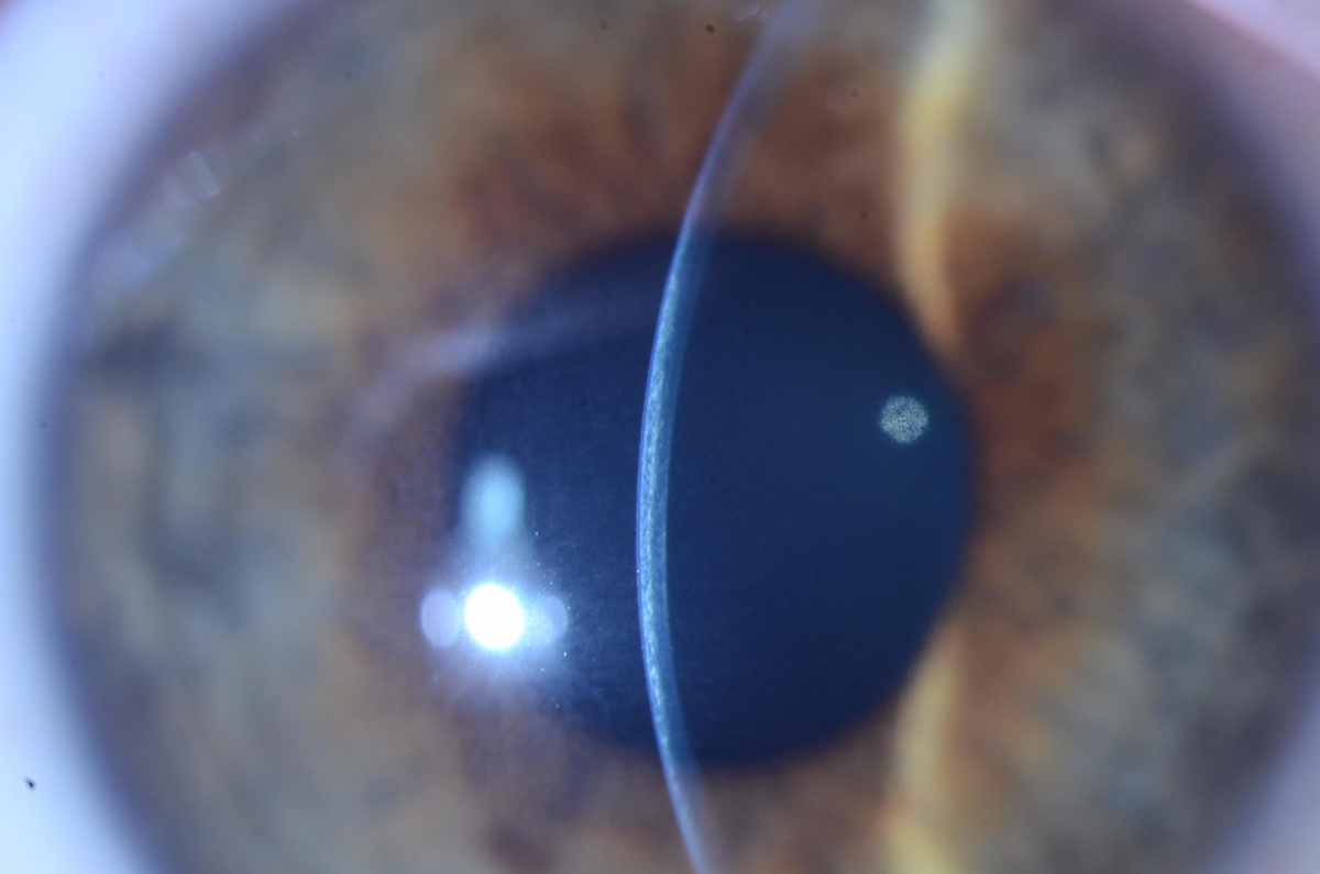 The slit beam in this patient demonstrates a demarcation line at about 50% to 60% corneal depth.