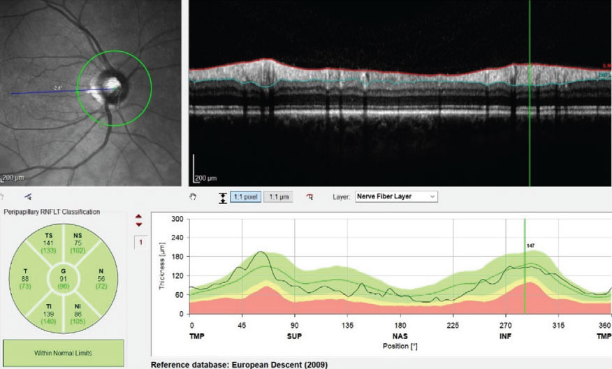 Fig. 1. This image shows an entirely normal RNFL circle scan on initial presentation of the right eye.
