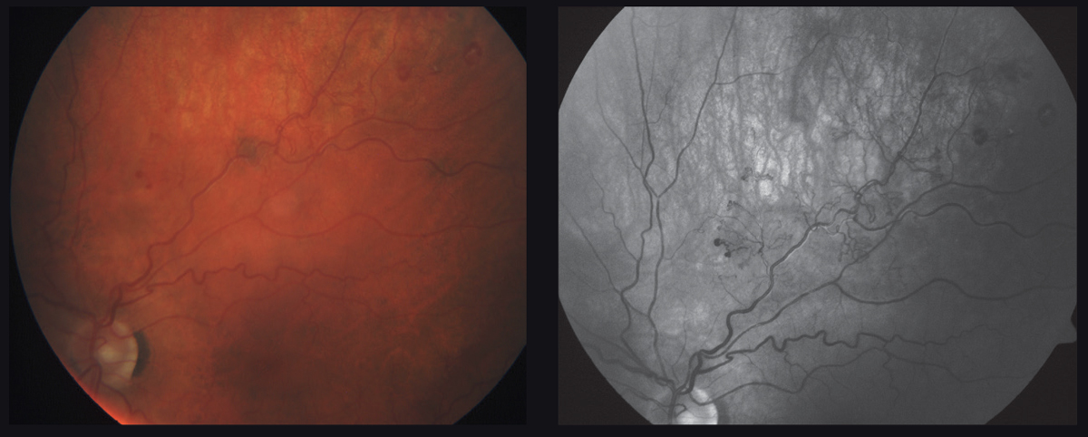 This 61-year-old patient’s left eye has an ischemic branch retinal vein occlusion with evidence of frank neovascular edema.