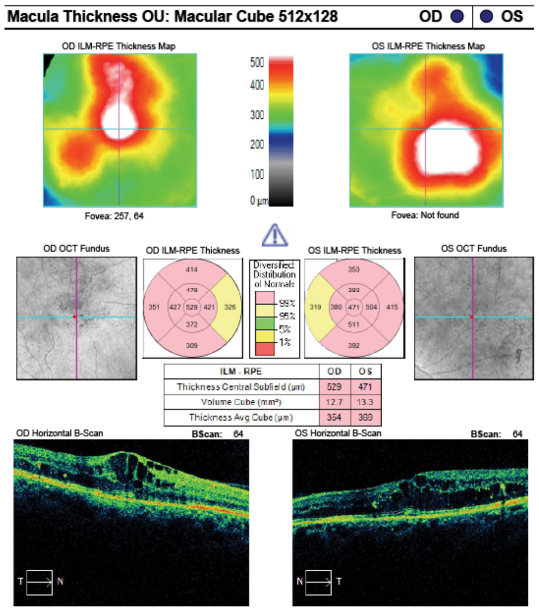 These macular cube analysis images of the same patient from the previous page shows clinically significant macular edema in both eyes.