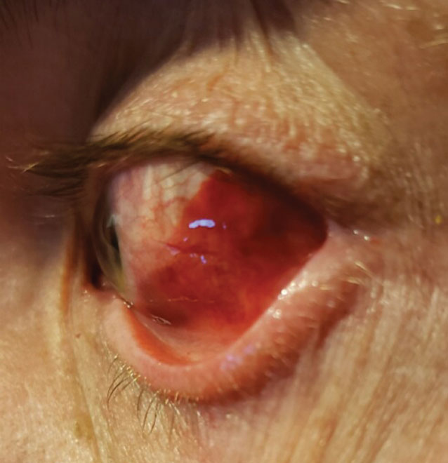 When assessing conjunctival laceration, subconjunctival hemorrhage may limit view of the sclera. 