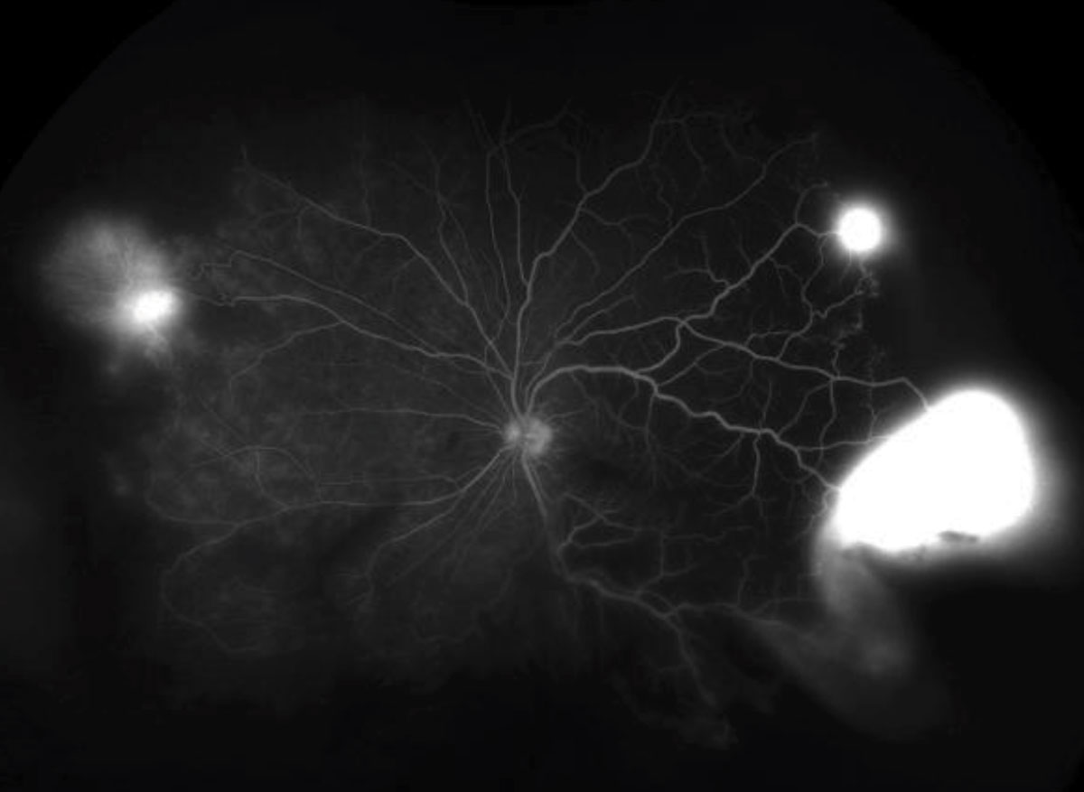 Fig. 3. These ultra-widefield FA images depict the late phase in both eyes. 