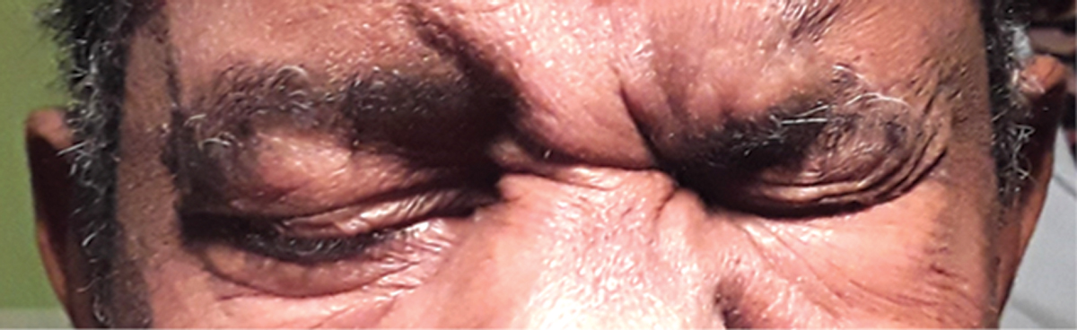 Fig. 6. The patient’s orbicularis function visibly improved by his six-week follow-up.