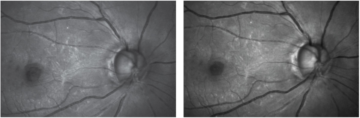 Figs. 2 and 3. Green laser imaging highlights the ERM and the foveal abnormality, at left. Blue laser reflectance imaging shows some fine striations remaining in the superotemporal sector of the arcuate retinal nerve fibers and very few nerve fibers remaining inferiorly.