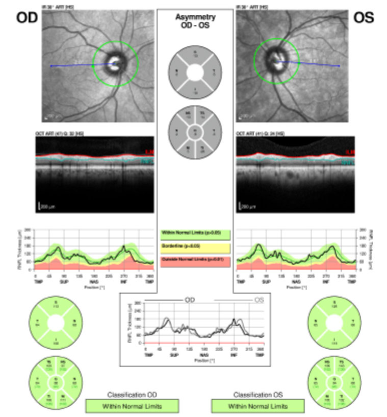 Fig.1. The patient’s retinal nerve fiber layer analysis at presentation shows no glaucomatous thinning for both eyes.