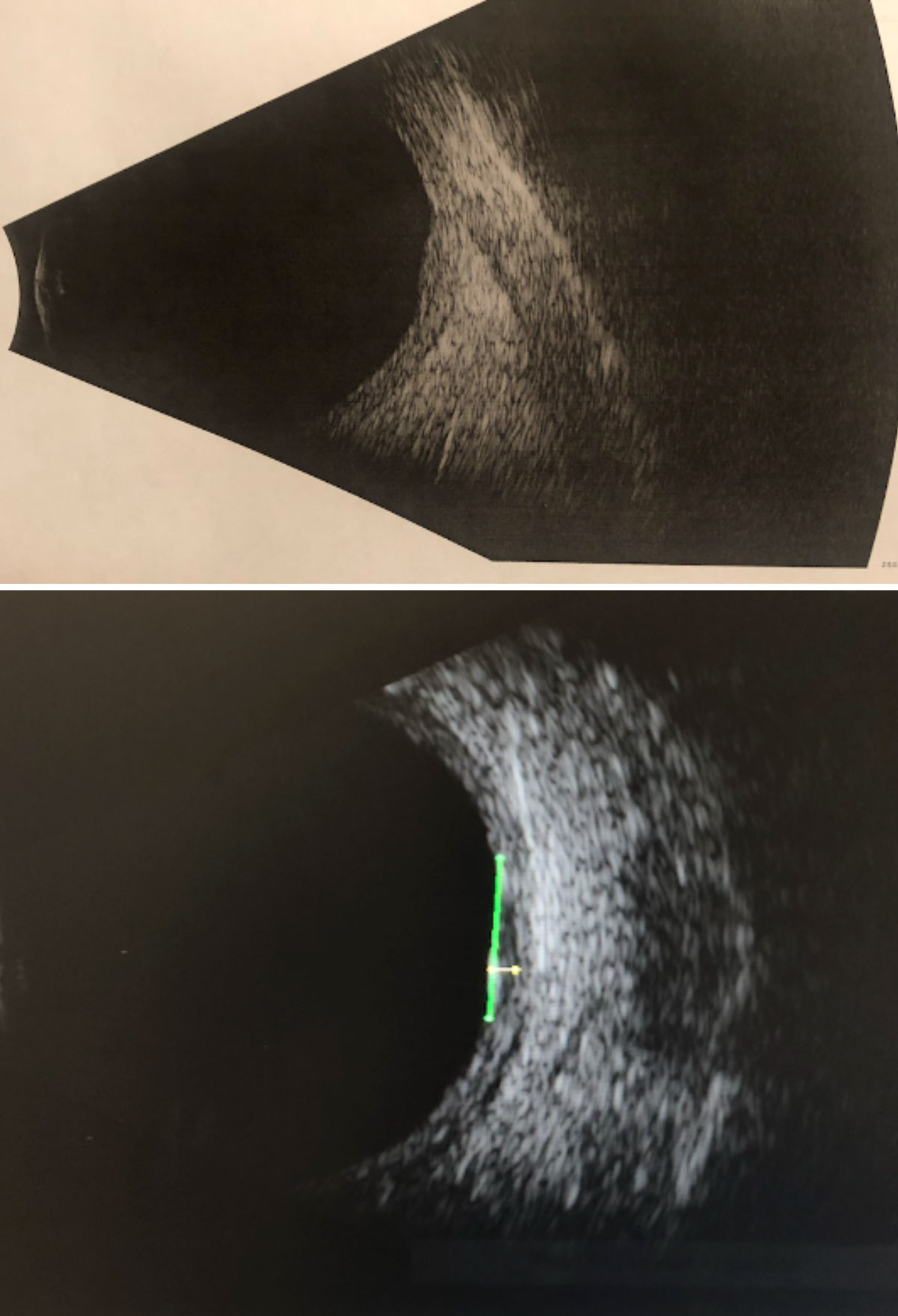 Fig. 11. B-scan ultrasonography through the suspicious lesion in the left eye without measurements (top) and with measurements (bottom): High internal reflectivity; transverse = 6.76mm; longitudinal = 5.92mm; horizontal (thickness) = 1.11mm. 