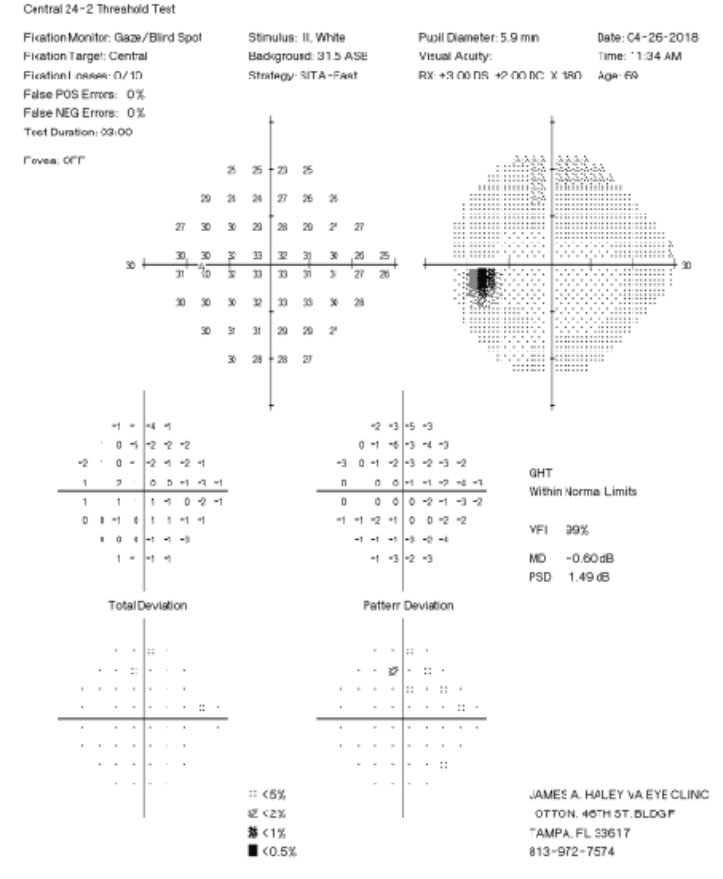 Fig. 2. His 24-2 visual fields the year prior show no glaucomatous visual field defects.