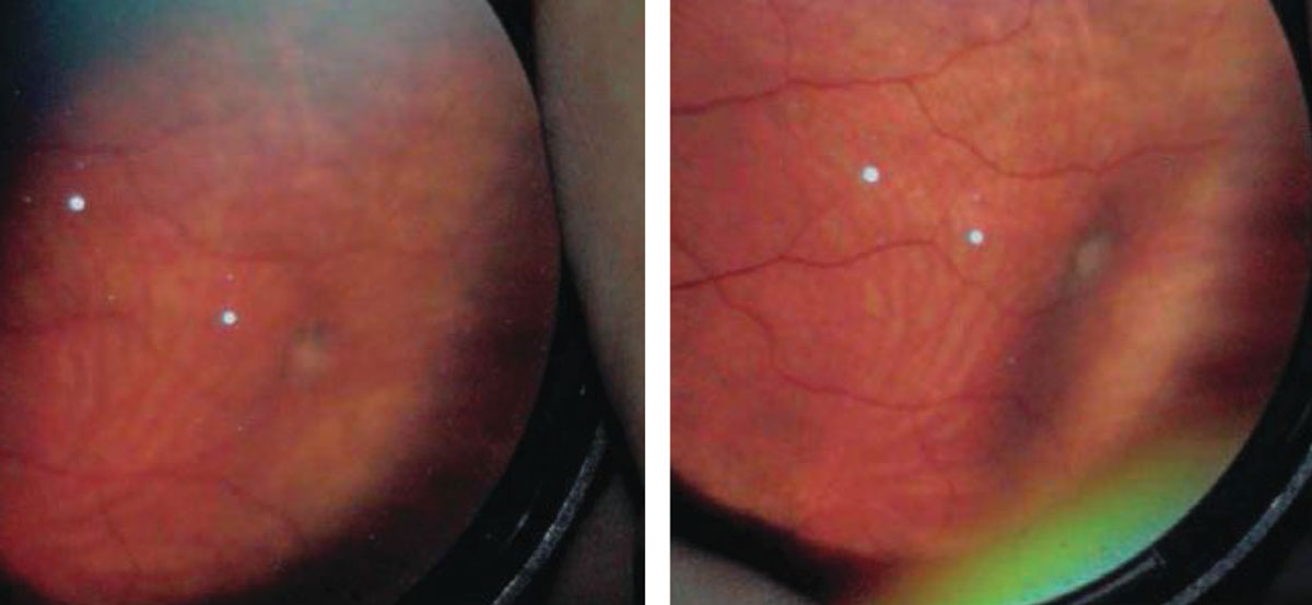 In this patient with a retinal traction tuft (left), applying scleral depression provided better detail of the lesion. Photos: Amy Dinardo, OD, MBA, and Philip Walling, OD.