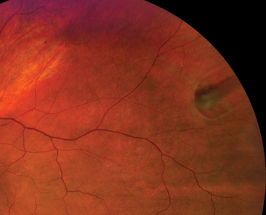 Refer any horseshoe retinal tear case emergently for prophylactic treatment.
