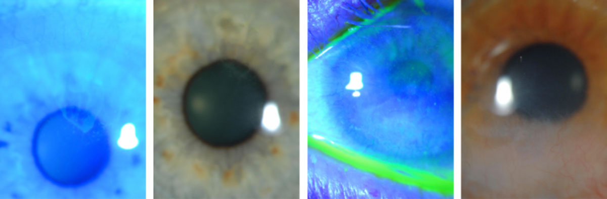 LSCD in two different contact lens wearers shows a typical dull haze/irregular reflex with a “whorl,” conjunctivalized cornea (white light) and a late, stippled fluorescein effect (cobalt filter).