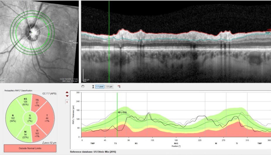 Follow-up RNFL circle OCT scans OS compared with baseline. Note in the area marked on the TSNIT graph a 115μm decrease in thickness from baseline. In conjunction with the last image, it is clear that this is glaucomatous change.