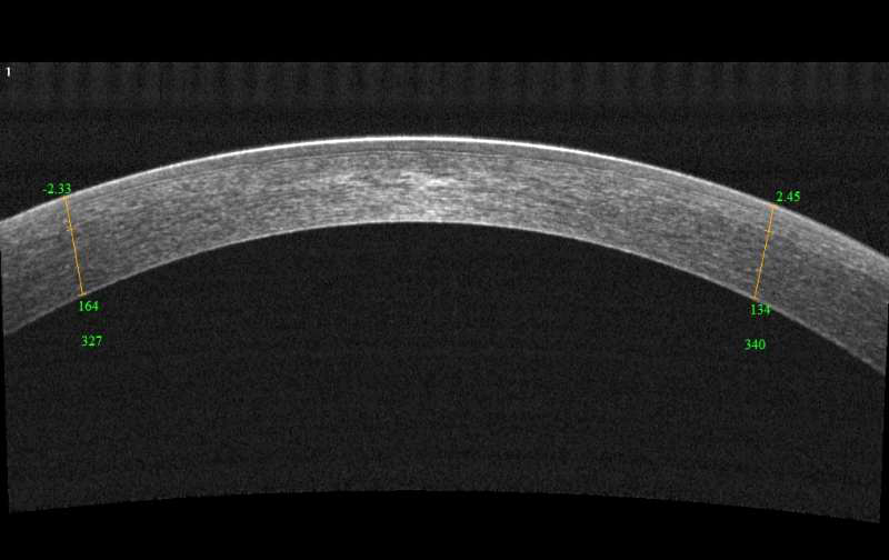 OCT measurements were found to accurately quantify corneal astigmatism in keratoconus patients.