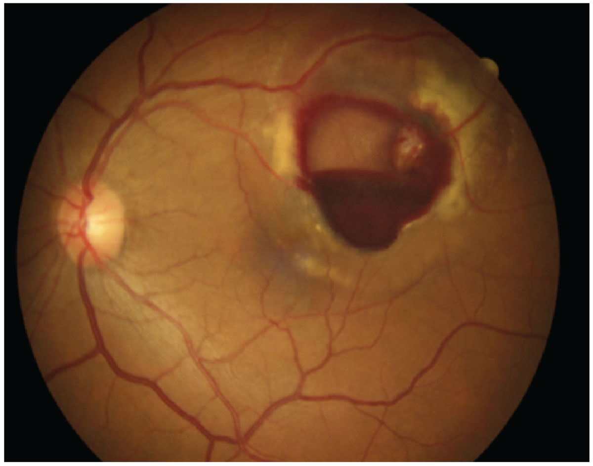Fig. 3. Retinal arterial microaneurysm.